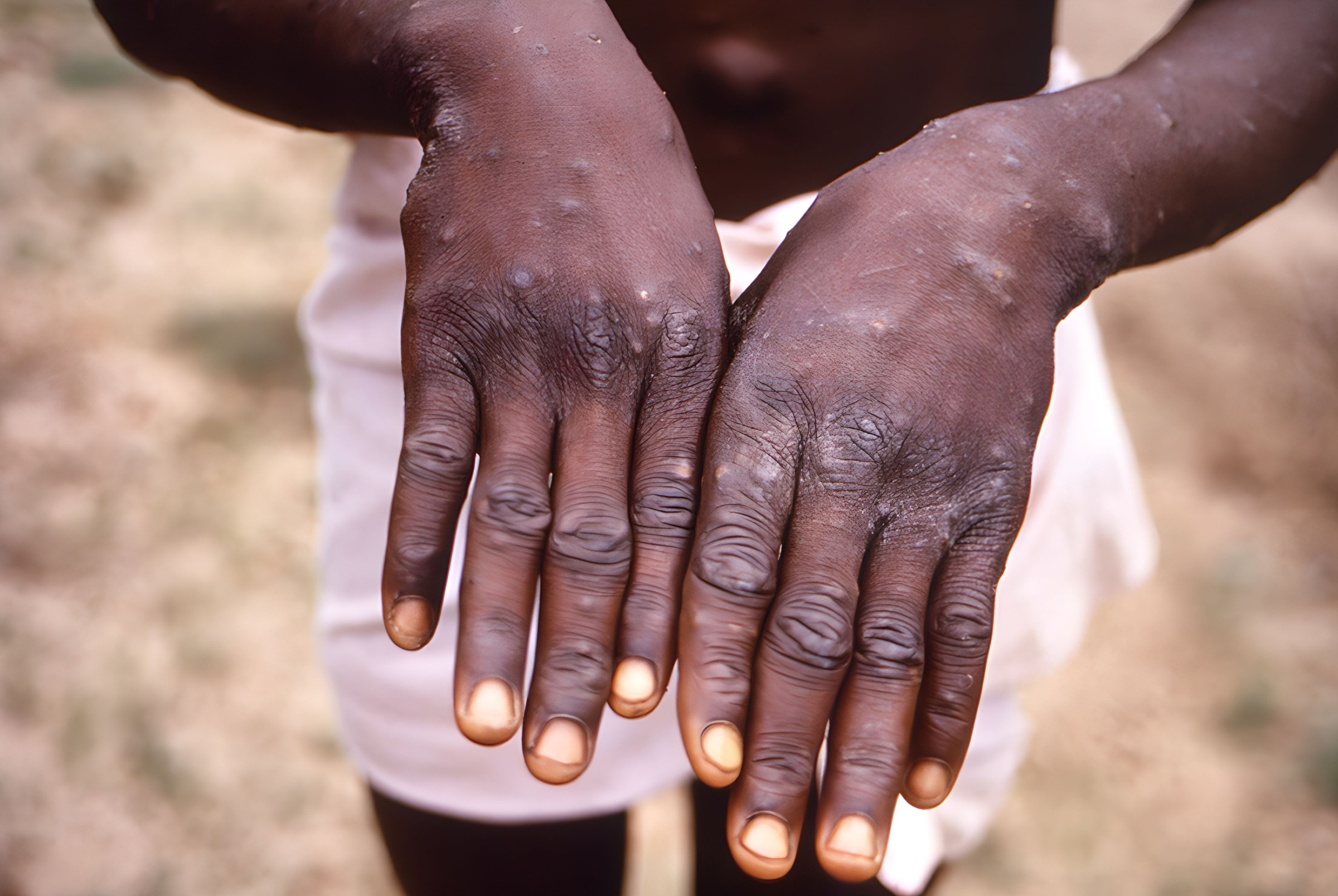 Factsheet: Protecting yourself from Mpox 